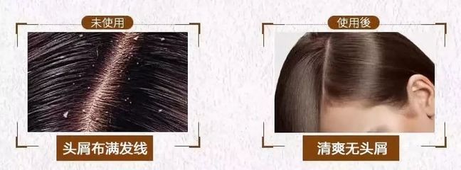 告別脫發、頭皮屑與頭發稀少的煩惱，重塑烏黑濃密的秀發